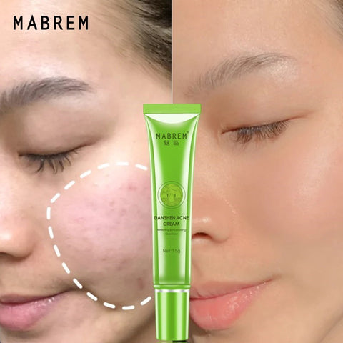 Effective Acne Removal Cream Acne Treatment Fade Acne Spots Oil Control Shrink Pores Whitening Moisturizing Acne Cream Skin Care