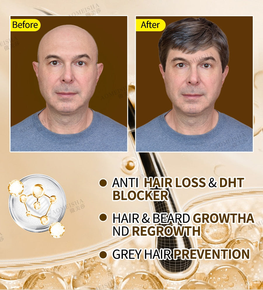 Powerful hair growth Anti-hair loss Anti-baldness Fast hair growth Hair loss treatment Hair regrowth Fast Hair Growth Oil