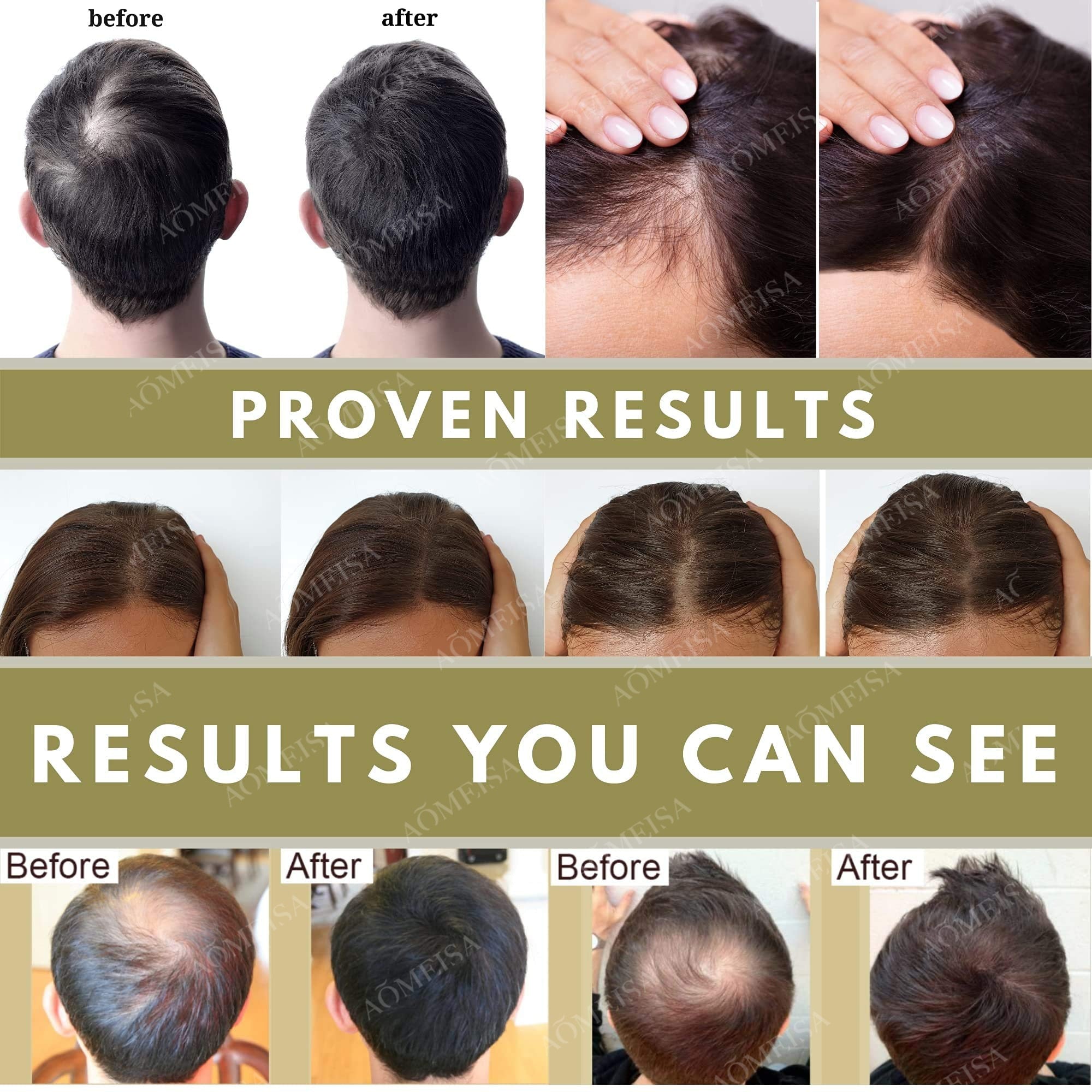 Powerful hair growth Anti-hair loss Anti-baldness Fast hair growth Hair loss treatment Hair regrowth Fast Hair Growth Oil