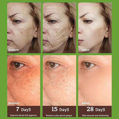 Freckle Whitening Cream Black Dots Melasma Remover Anti Brown Stain Lighten Pigmentation Moisturizing Skin Care Products 2023