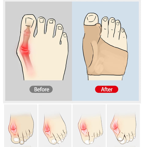 2 uds = 1 par de correctores ortopédicos para el cuidado de los pies, ajustador del pulgar, corrección, calcetines suaves para pedicura, alisador de juanetes 