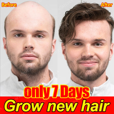 Powerful hair growth Anti-hair loss Anti-baldness Fast hair growth Hair loss treatment Hair regrowth Fast Hair Growth Oil