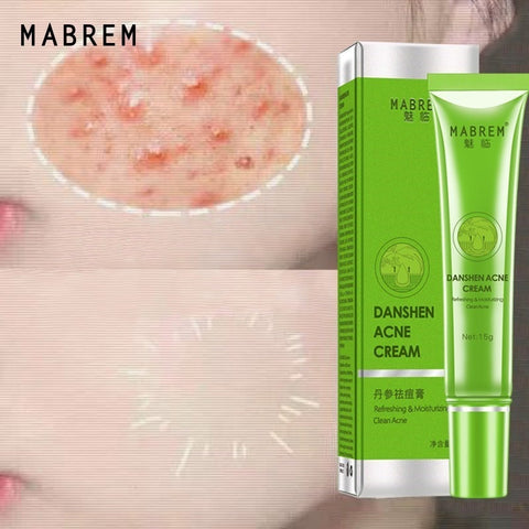 Effective Acne Removal Cream Acne Treatment Fade Acne Spots Oil Control Shrink Pores Whitening Moisturizing Acne Cream Skin Care